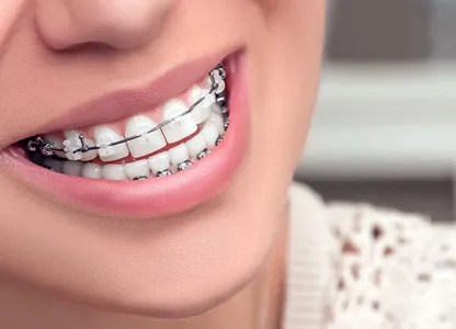 Ceramic Braces