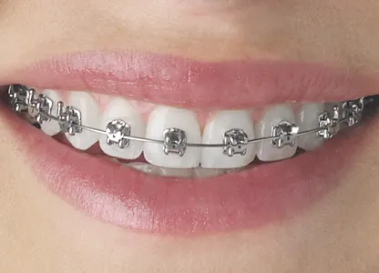 Conventional Metal Braces