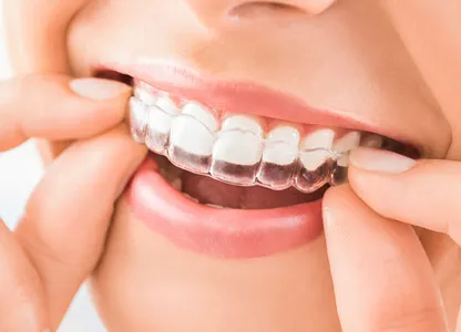 Invisalign aligners